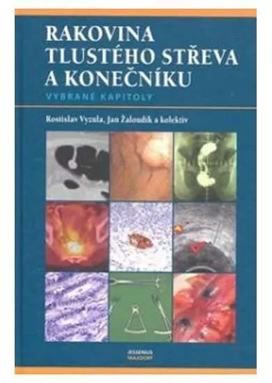 Rakovina tlustého střeva a konečníku - vybrané kapitoly
