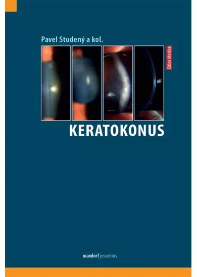 Keratokonus