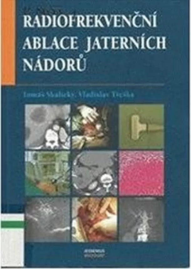 Tomáš Skalický, Vladislav Třeška  - Radiofrekvenční ablace jaterních nádorů