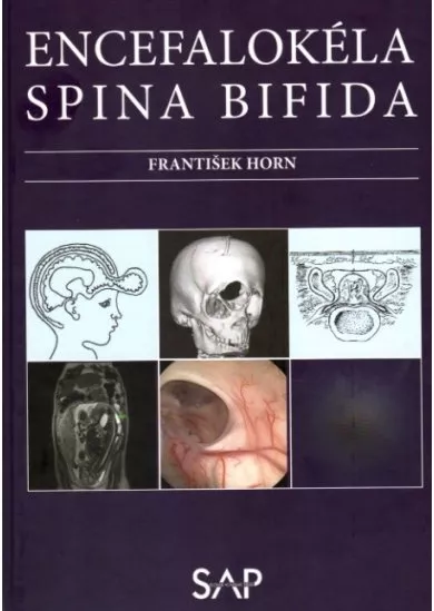 Encefalokéla spina bifida