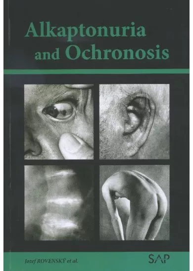 Alkaptonuria and ochronosi